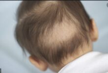 What Causes Hair Loss in Babies Prevention and Symptoms
