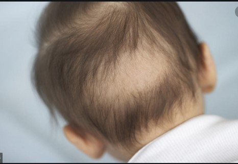 What Causes Hair Loss in Babies Prevention and Symptoms
